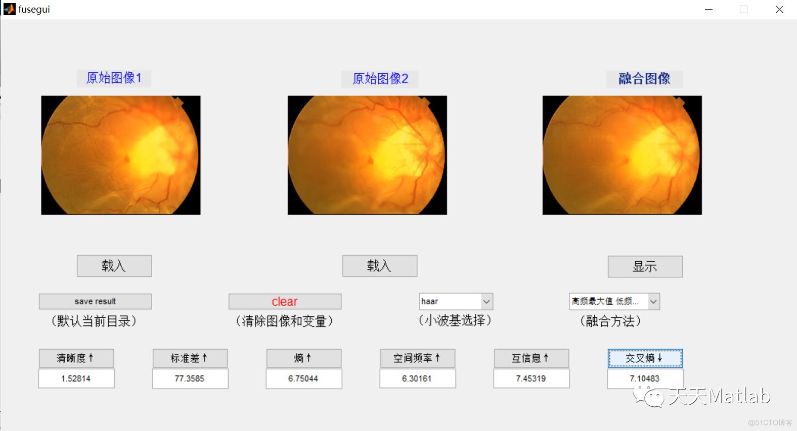 【图像融合】基于小波变换实现CT图像融合（融合指标）含Matlab源码_图像融合