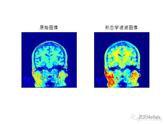 【图像去噪】基于Wiener、Non-Local Means、Lucy_Richardson、Lee、kuwahara、Bilateral多种滤波器实现CT图像去噪含Matlab源码_邻域