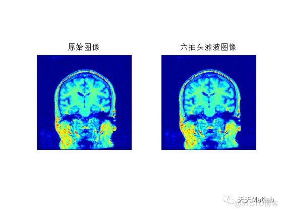 【图像去噪】基于Wiener、Non-Local Means、Lucy_Richardson、Lee、kuwahara、Bilateral多种滤波器实现CT图像去噪含Matlab源码_图像去噪_05