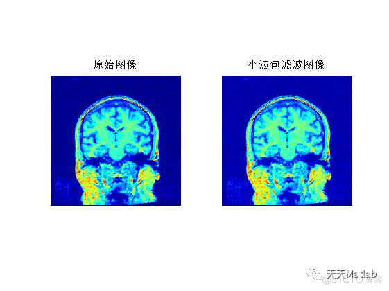 【图像去噪】基于Wiener、Non-Local Means、Lucy_Richardson、Lee、kuwahara、Bilateral多种滤波器实现CT图像去噪含Matlab源码_邻域_03