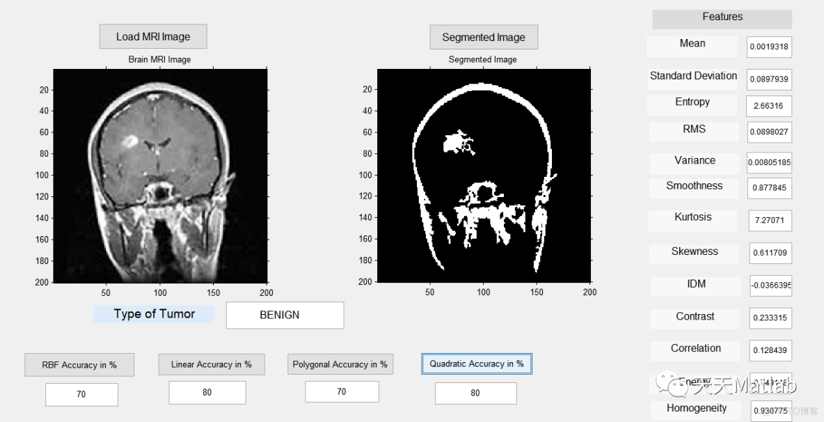 【图像检测】基于多种特征结合支持向量机实现脑 MRI 肿瘤检测和分类附Matlab 代码_5e_02